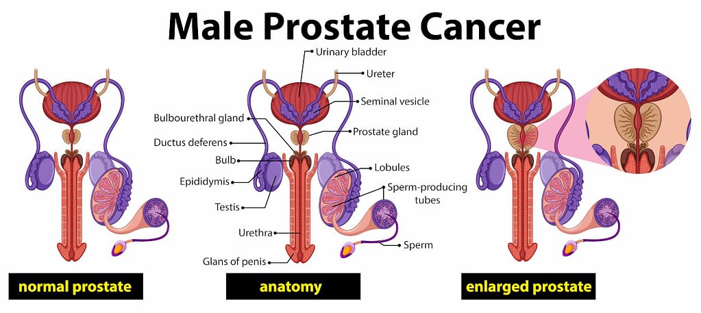 Cáncer de Próstata